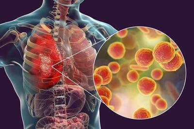  بستری ۱۵۹ بیمار حاد تنفسی در بیمارستان‌های گیلان