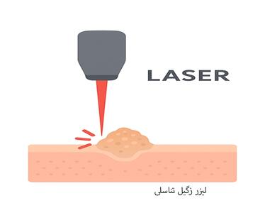  لیزر زگیل تناسلی در برابر کرایوتراپی و سوزاندن؛ کدام روش بهتر است؟