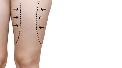  جراحی لیفت ران چیست و به چه روش هایی انجام می شود؟