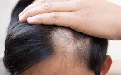 پیشگیری ریزش موی ارثی؛ روش های درمان و کنترل