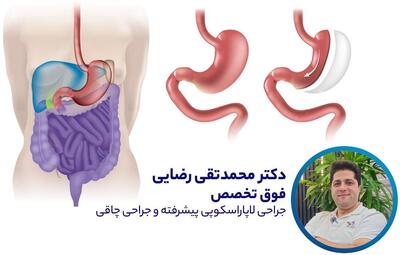  نظر دکتر محمدتقی رضایی متخصص جراحی چاقی در مورد اسلیو معده