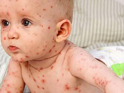  باید و نبایدهای دوره ابتلا به آبله مرغان