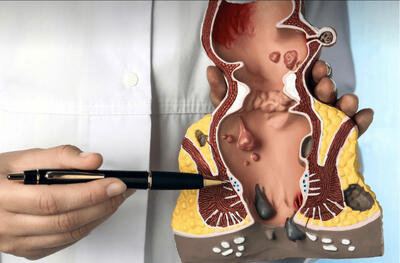  درمان فوری بواسیر، شقاق و فیستول بدون بیهوشی؛ روش‌های نوین ۱۴۰۴