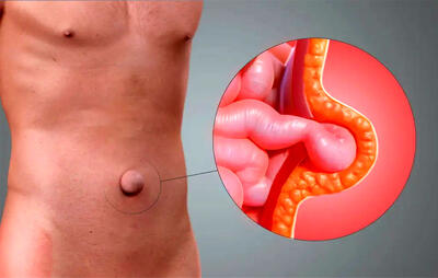  آیا می‌توان فتق را بدون بیهوشی درمان کرد؟ بررسی راهکارهای موجود