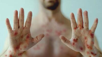  ۴۰٪ مبتلایان HIV مراجعه نمی‌کنن