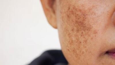 آلودگی هوا و پوست؛ چگونه از التهاب و خطر سرطان پیشگیری کنیم؟