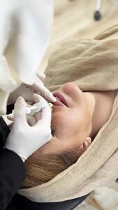  تزریق ژل لب طبیعی