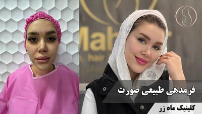  ✨ فرم‌دهی طبیعی صورت با تزریق چربی ( کلینیک زیبایی ماه زر )