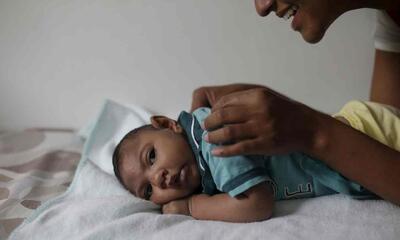 میانگین عمر کودکان مبتلا به میکروسفالی