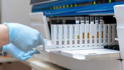 یک آزمایش جدید، سرطان مثانه را با دقت بالایی تشخیص می‌دهد