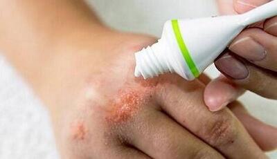  آلرژی‌های ناشی از محصولات آرایشی، چالشی جدی اما قابل پیشگیری