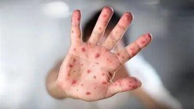 هشدار سازمان جهانی بهداشت؛ شیوع جهانی سرخک با سرعت