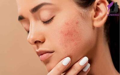 آلرژی ناشی از لوازم آرایشی؛ شایع اما قابل پیشگیری