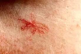 دلیل ظهور «رگ‌های عنکبوتی» (روزاسه) روی صورت چیست؟