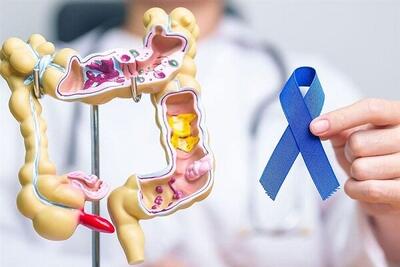  پیشگیری از سرطان با میکروبیوم روده