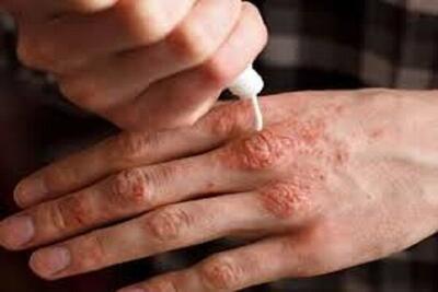 تمرکز بر علائم دلیل سختی تشخیص بیماری‌های خودایمنی