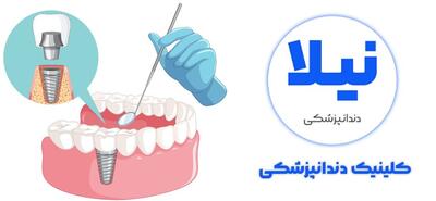  افزایش تقاضای ایمپلنت دندان در تهران و کرج