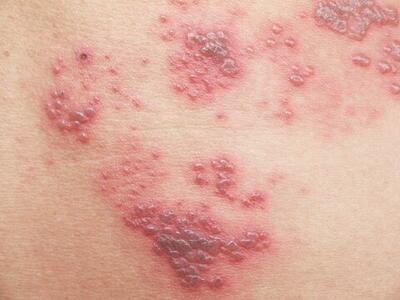  ویژگی‌های خاص واکسن زونا