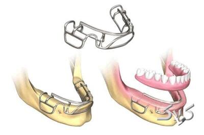 ایمپلنت ساب پریوستئال در کلینیک دندانپزشکی مدرن - مجله اینترنتی کولاک