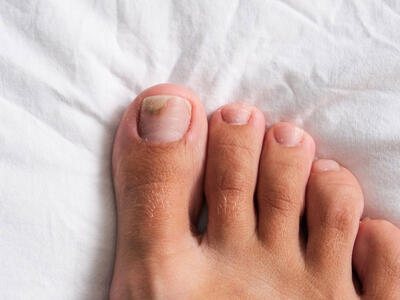  بهترین روش های درمان قارچ ناخن دست و پا