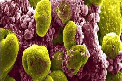 تاثیر یک ترکیب دارویی در کاهش خطر مرگ ناشی از سرطان