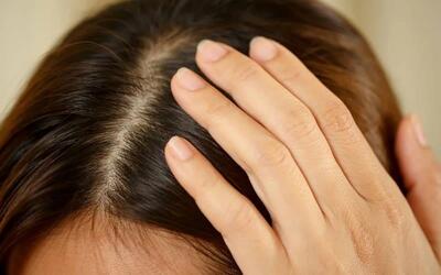 دلایل خشکی پوست سر؛ درمان و پیشگیری (مراحل درمان و انواع شامپو)