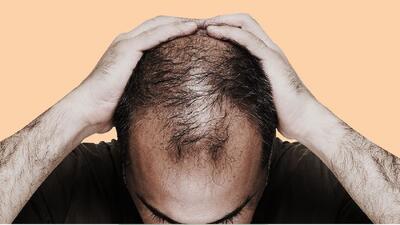  چگونه استرس فولیکول‌های مو را به یک هدف ایمنی تبدیل می‌کند؟