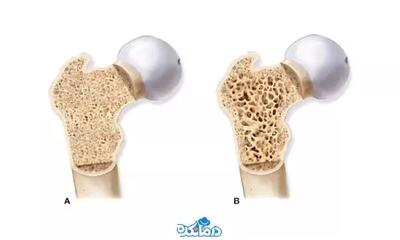 این ویتامین ها برای پوکی استخوان معجزه می‌کنند / ویتامین‌های ضروری برای مقابله با پوکی استخوان و تقویت استخوان‌ها / رازهای سلامتی: ویتامین‌هایی که مانع پوکی استخوان می‌شوند