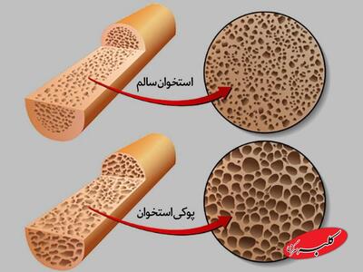  ۲ ویتامین مهم برای قوی شدن استخوان ها و جلوگیری از پوکی استخوان - کلبه سرگرمی