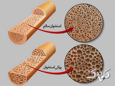 ۲ ویتامین مهم برای قوی شدن استخوان ها و جلوگیری از پوکی استخوان - مجله اینترنتی کولاک