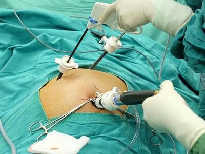  هیستروسکوپی و لاپاراسکوپی زنان؛ درمان ناباروری و موفقیت IVF
