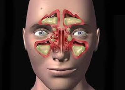  آلودگی هوا چگونه موجب تشدید سینوزیت مزمن می‌شود؟