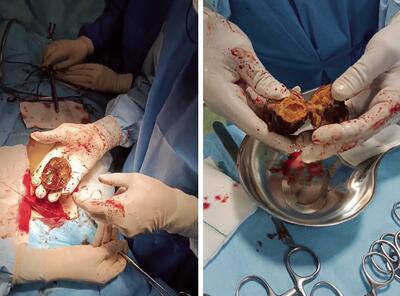 حاوی تصاویر دلخراش؛ بیرون کشیدن خرمالو از شکم یک بیمار!