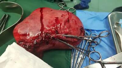 خروج توده حدود ۲ کیلویی از شکم یک بیمار