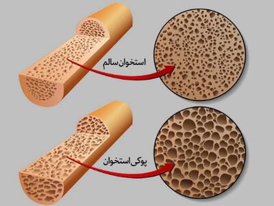  ۲ ویتامین مهم برای قوی شدن استخوان ها و جلوگیری از پوکی استخوان