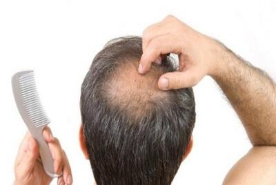  خداحافظی با طاسی؛ کشف داروی جدید | الگوی طاسی مردانه چگونه است؟