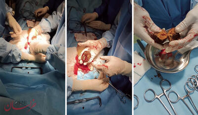 ماجرای وحشتناک   خرمالو   در اتاق های عمل!