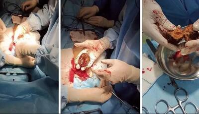 ماجرای وحشتناک «خرمالو» در اتاق‌های عمل!