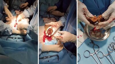 توده های مرموز خرمالو در معده بیماران مشهد