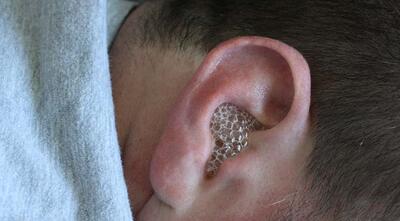 آیا عفونت گوش نیاز به آنتی بیوتیک دارد؟