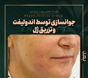  اندولیفت یا هایفو؛ کدام روش جوان‌سازی پوست بهتر است؟ / مزایا و معایب هر تکنیک از زبان متخصصان زیبایی / راهنمای انتخاب روش ایده‌آل برای نتایج شگفت‌انگیز | اندیشه قرن