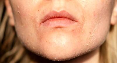 خشکی پوست در سرمای هوا چطور درمان می‌شود؟ / پوست‌تان در زمستان ترک می‌خورد؟ ۷ راه‌حل انفجاری برای نجات از خشکی سرمای هوا!