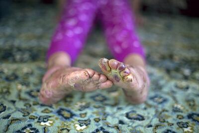 ۵ شکایت رسمی بیماران پروانه‌ای از بنیاد بیماری‌های خاص | ماجرای رها شدن یک نوزاد پروانه‌ای در بیمارستان