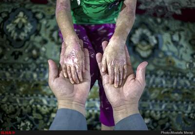 بنیاد امور بیماری‌های خاص هنوز به شکایات و مطالبات بیماران‌ پروانه‌ای پاسخی نداده است!