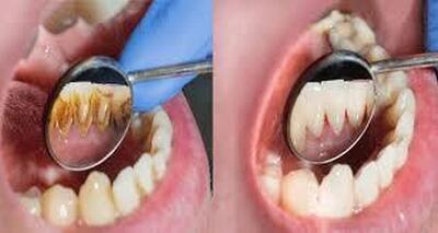 جرم دندان چطور می‌تواند باعث حمله قلبی و سکته شود؟