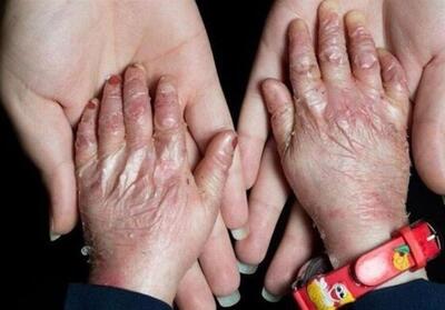 گوشه‌ای از مصائب بیماران پروانه‌ای/دست‌هایی که با پانسمان گره خورده‌اند/ زندگی با بیماری نادر! - تسنیم