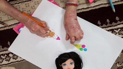 بنیاد امور بیماری‌های خاص به مطالبات بیماران پروانه‌ای پاسخی نمی دهد