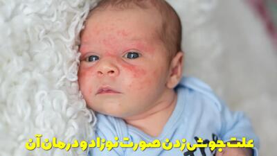  علت جوش زدن صورت نوزاد + بهترین درمان برای جوشهای صورت نوزاد