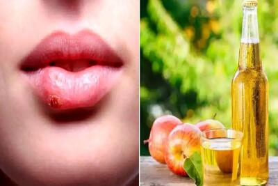  نابود کردن تبخال در همان روز اول؛ با این ژل تو نطفه خفه اش میکنی جاشم میره