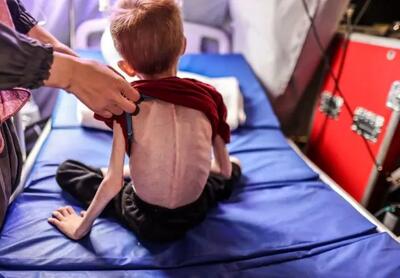 سوء تغذیه همچنان در غزه قربانی می‌گیرد